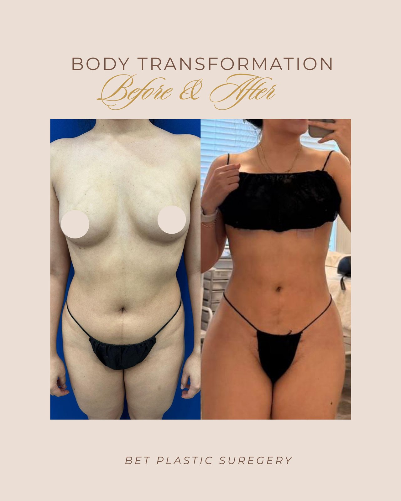 Resultado real de paciente de Dr. Bart Kachniarz en BET Aesthetics Center