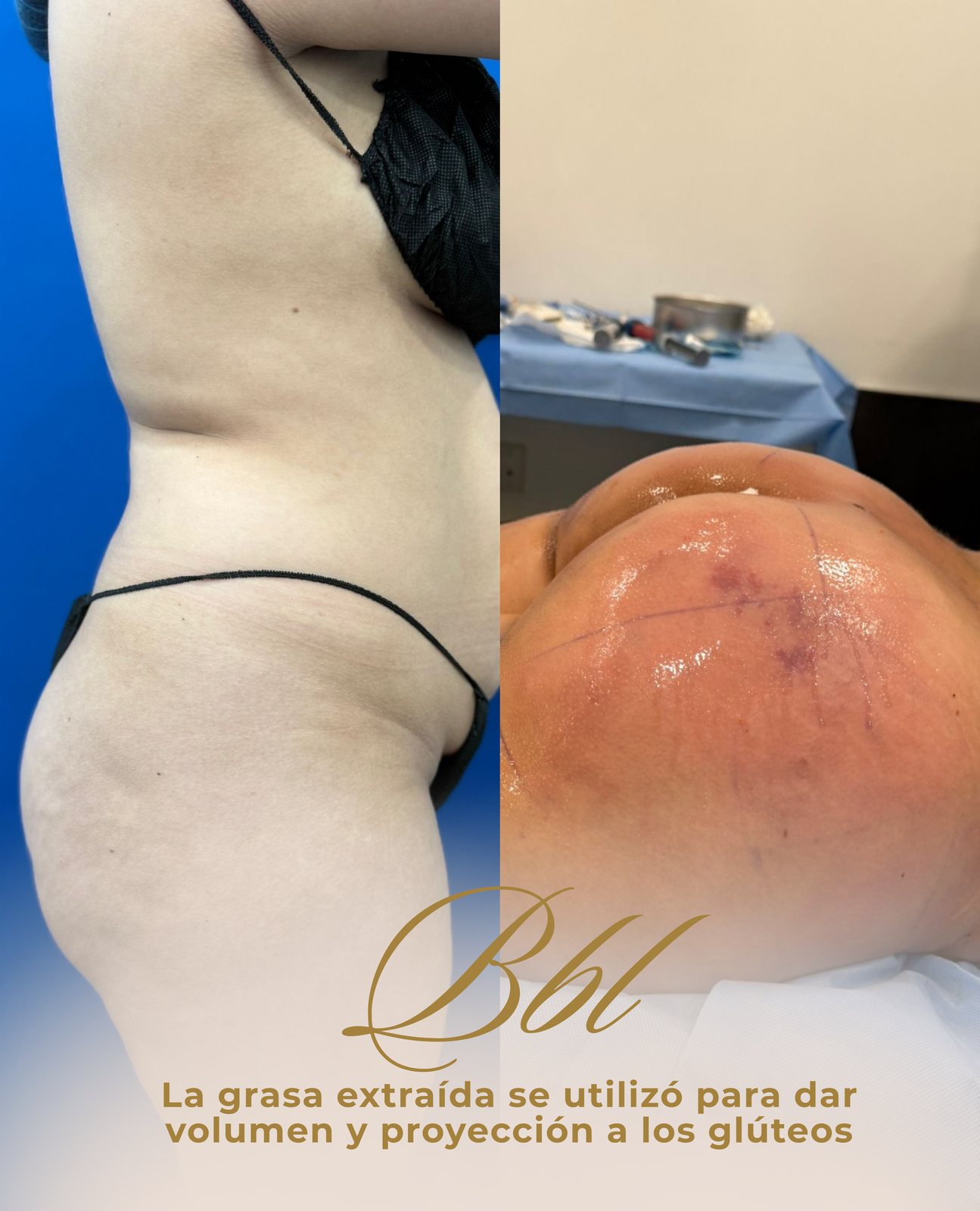 Resultado real de paciente de Dr. Bart Kachniarz en BET Aesthetics Center