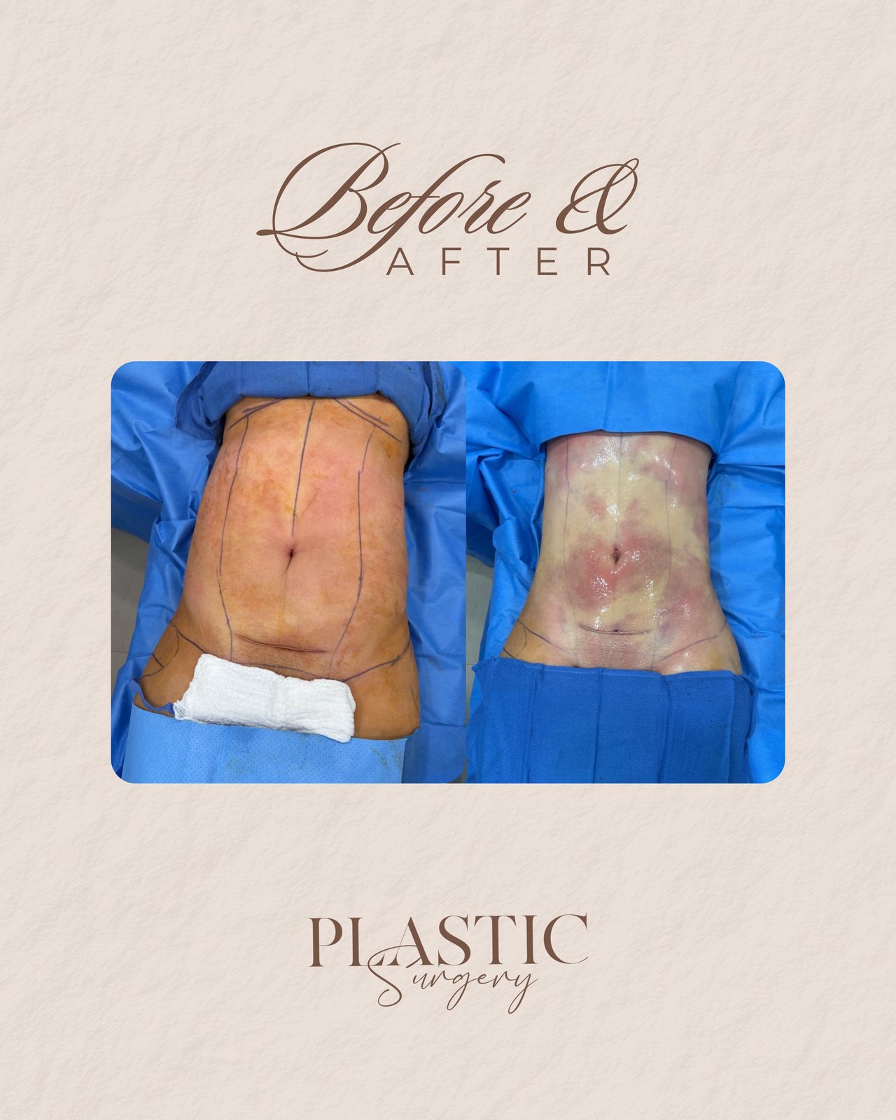 Resultado real de paciente de Dr. Bart Kachniarz en BET Aesthetics Center