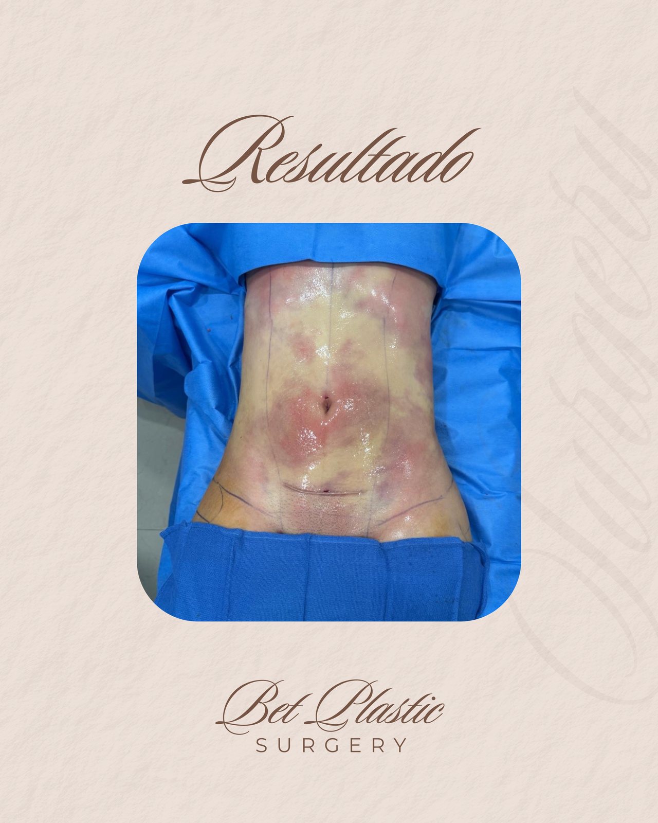 Resultado real de paciente de Dr. Bart Kachniarz en BET Aesthetics Center