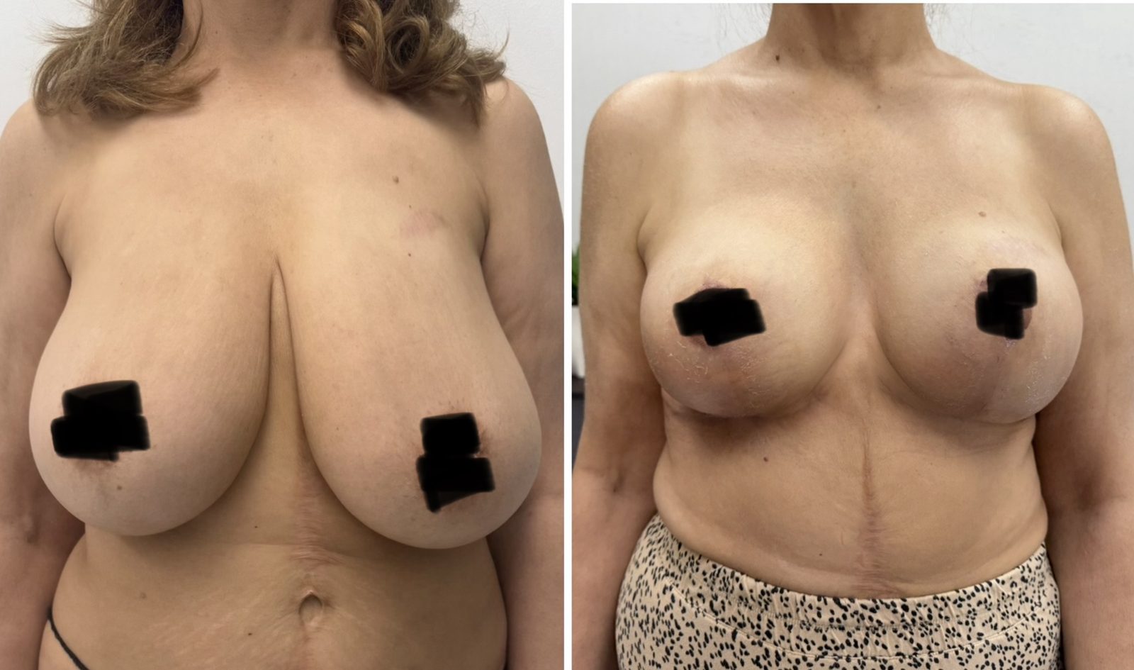 Resultado real de paciente de Dr. Felippe Sartorato en BET Aesthetics Center
