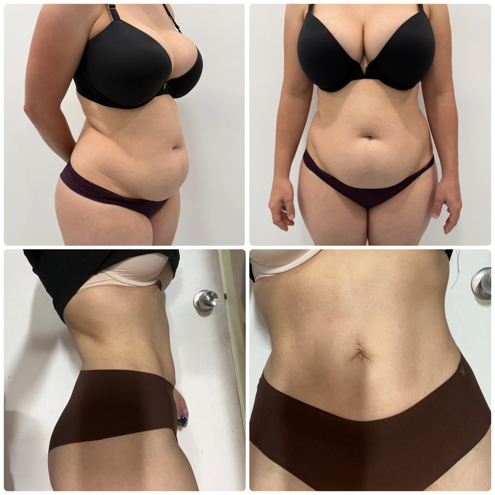 Resultado real de paciente de Dr. Felippe Sartorato en BET Aesthetics Center