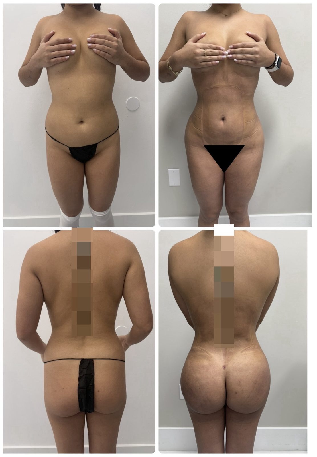 Resultado real de paciente de Dr. Felippe Sartorato en BET Aesthetics Center