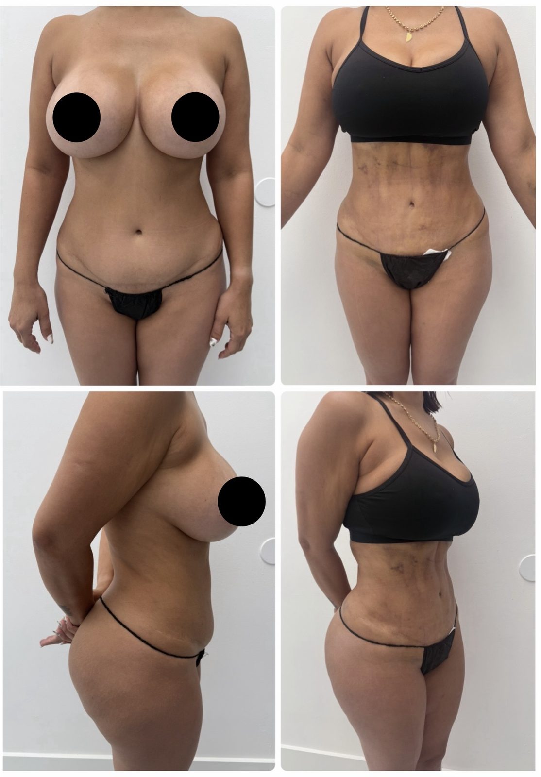 Resultado real de paciente de Dr. Felippe Sartorato en BET Aesthetics Center