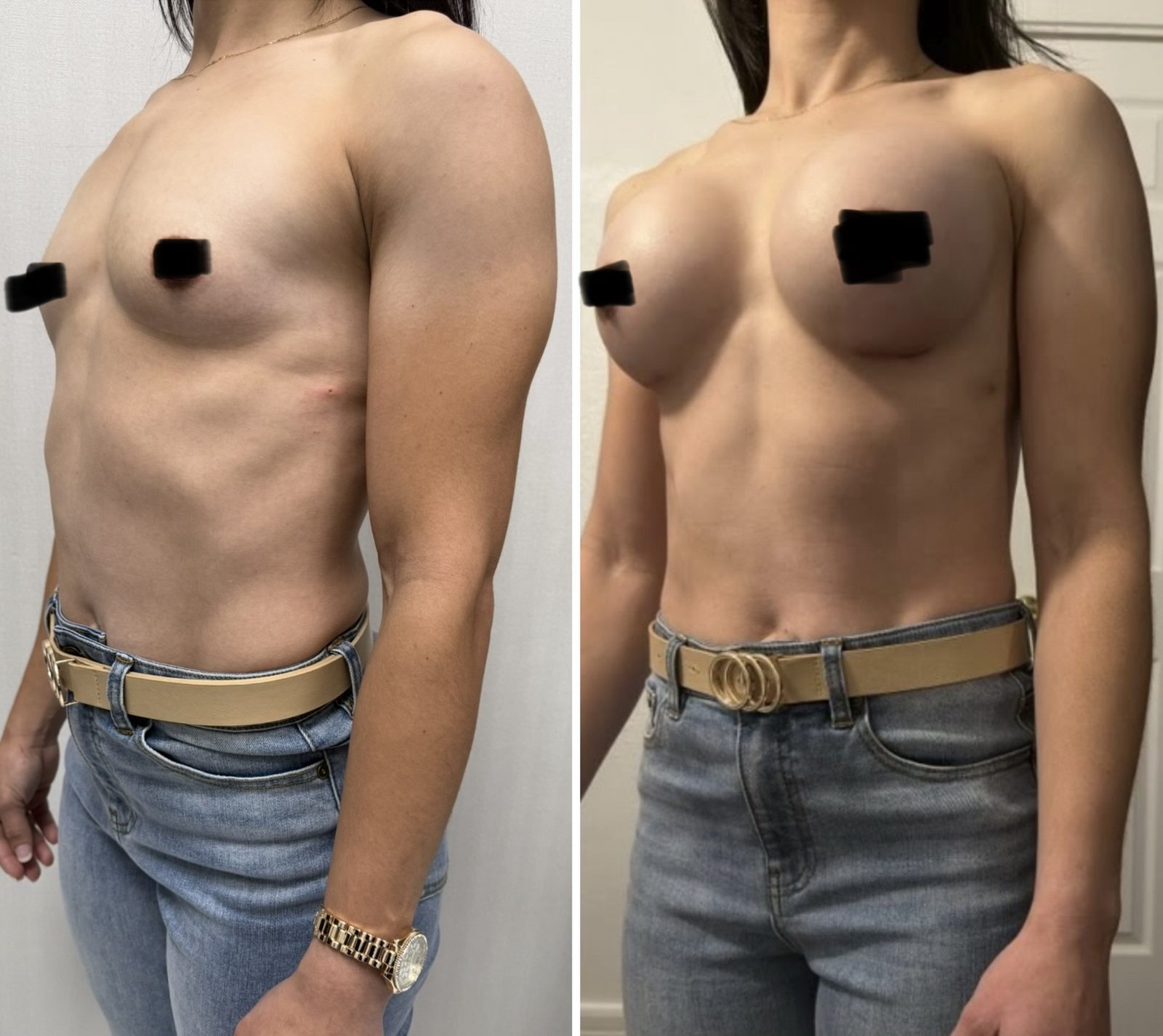 Resultado real de paciente de Dr. Felippe Sartorato en BET Aesthetics Center