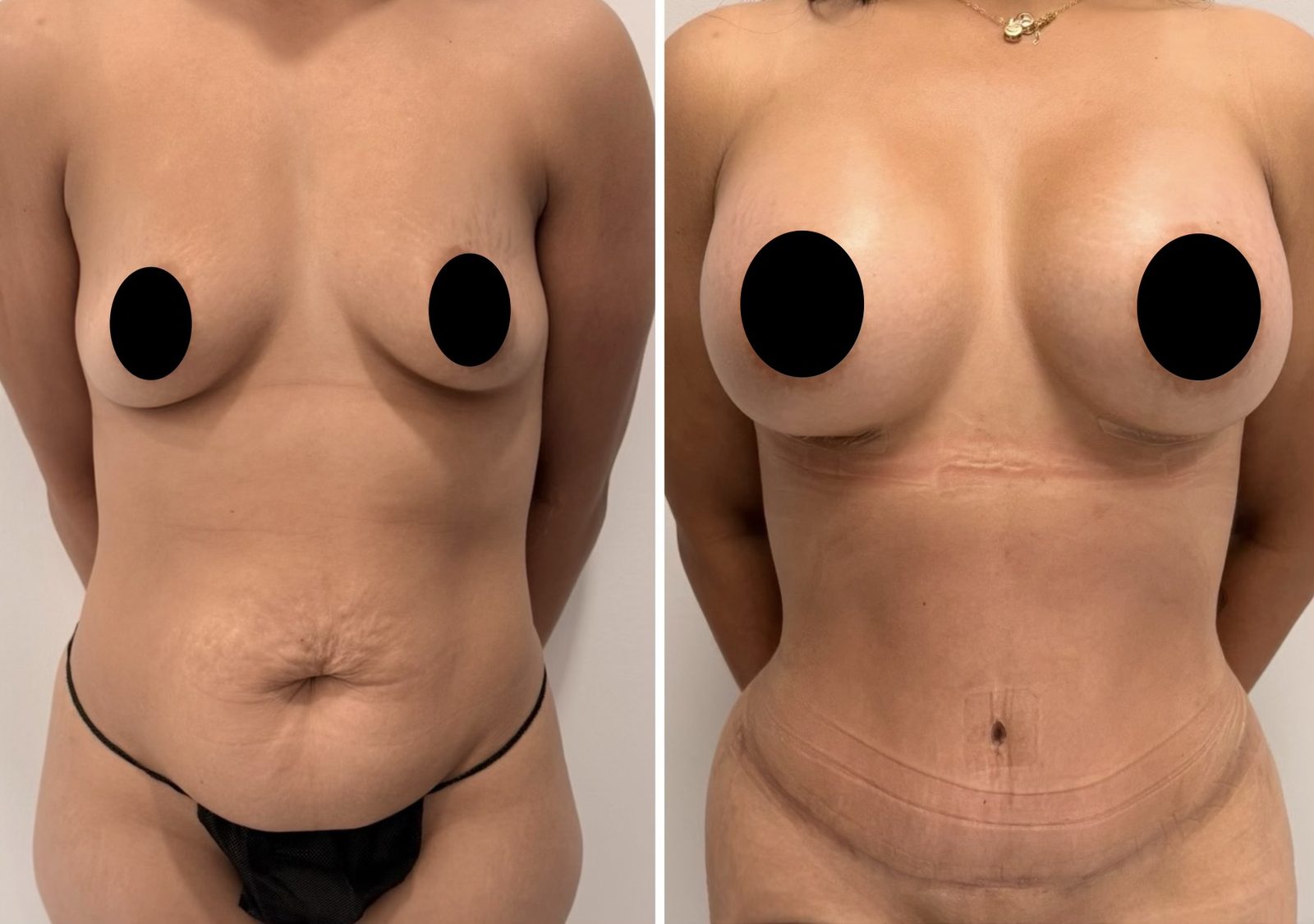 Resultado real de paciente de Dr. Felippe Sartorato en BET Aesthetics Center
