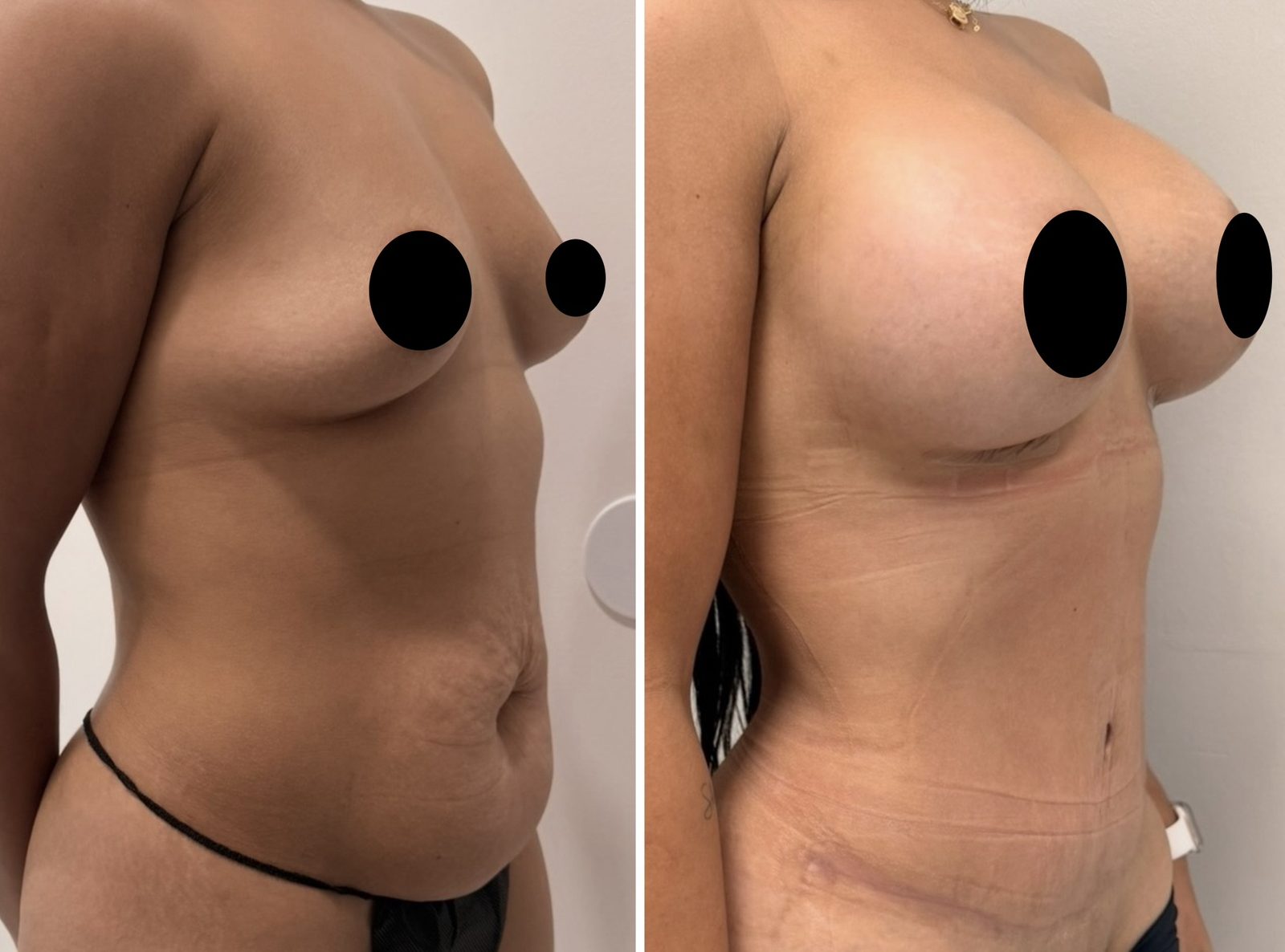 Resultado real de paciente de Dr. Felippe Sartorato en BET Aesthetics Center