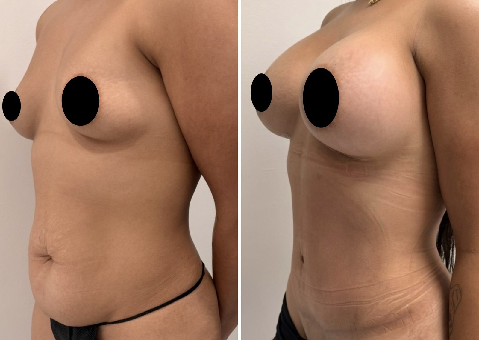 Resultado real de paciente de Dr. Felippe Sartorato en BET Aesthetics Center