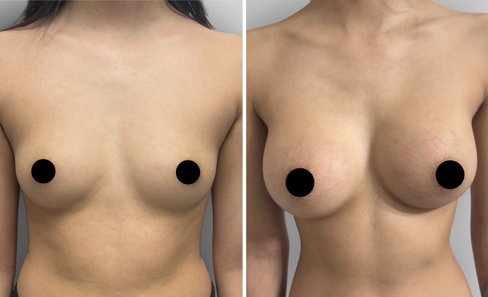 Resultado real de paciente de Dr. Felippe Sartorato en BET Aesthetics Center