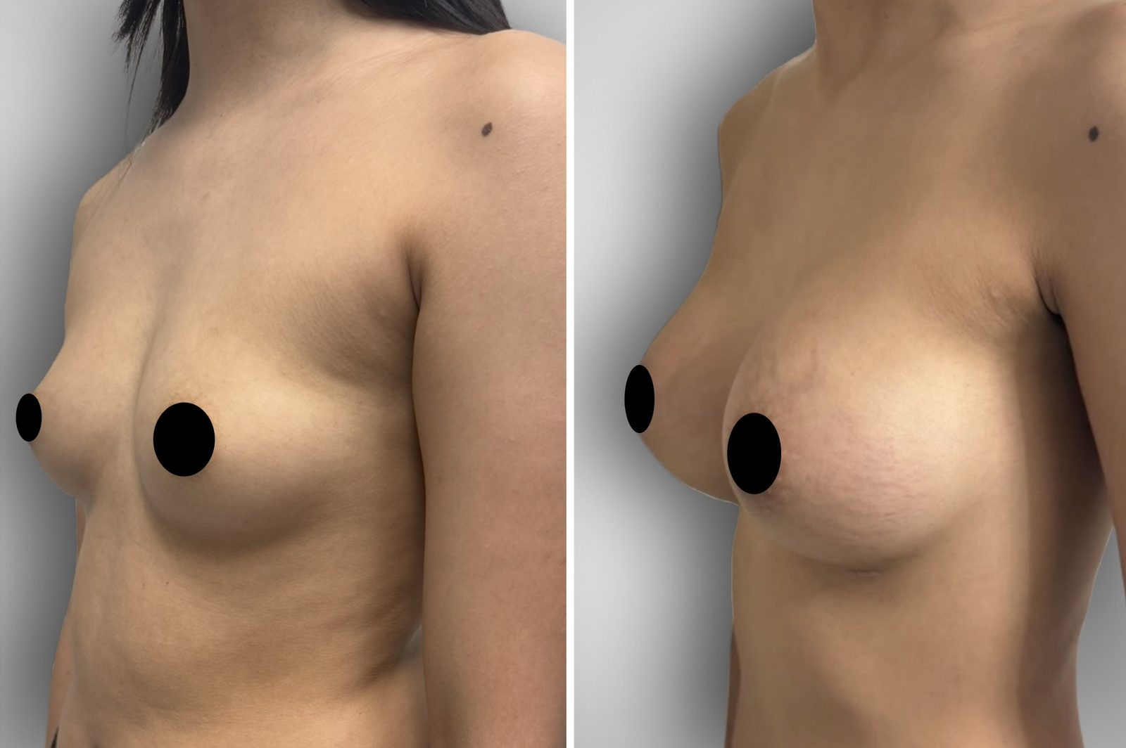 Resultado real de paciente de Dr. Felippe Sartorato en BET Aesthetics Center