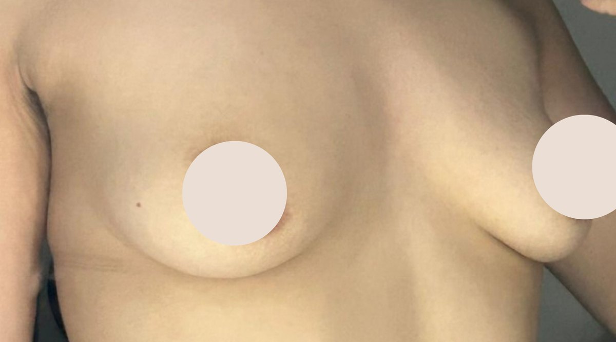 Antes de Aumento de Senos — paciente real de BET Aesthetics Center