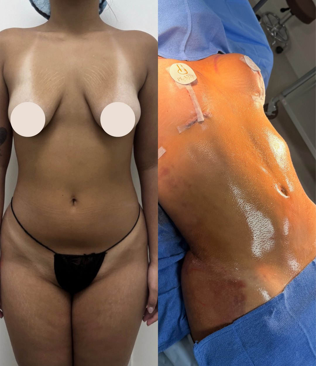 Paciente real de Lipo 360° en BET Aesthetics Center