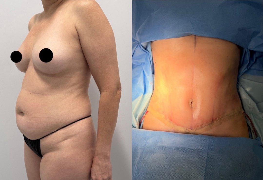 Paciente real de Lipo 360° en BET Aesthetics Center