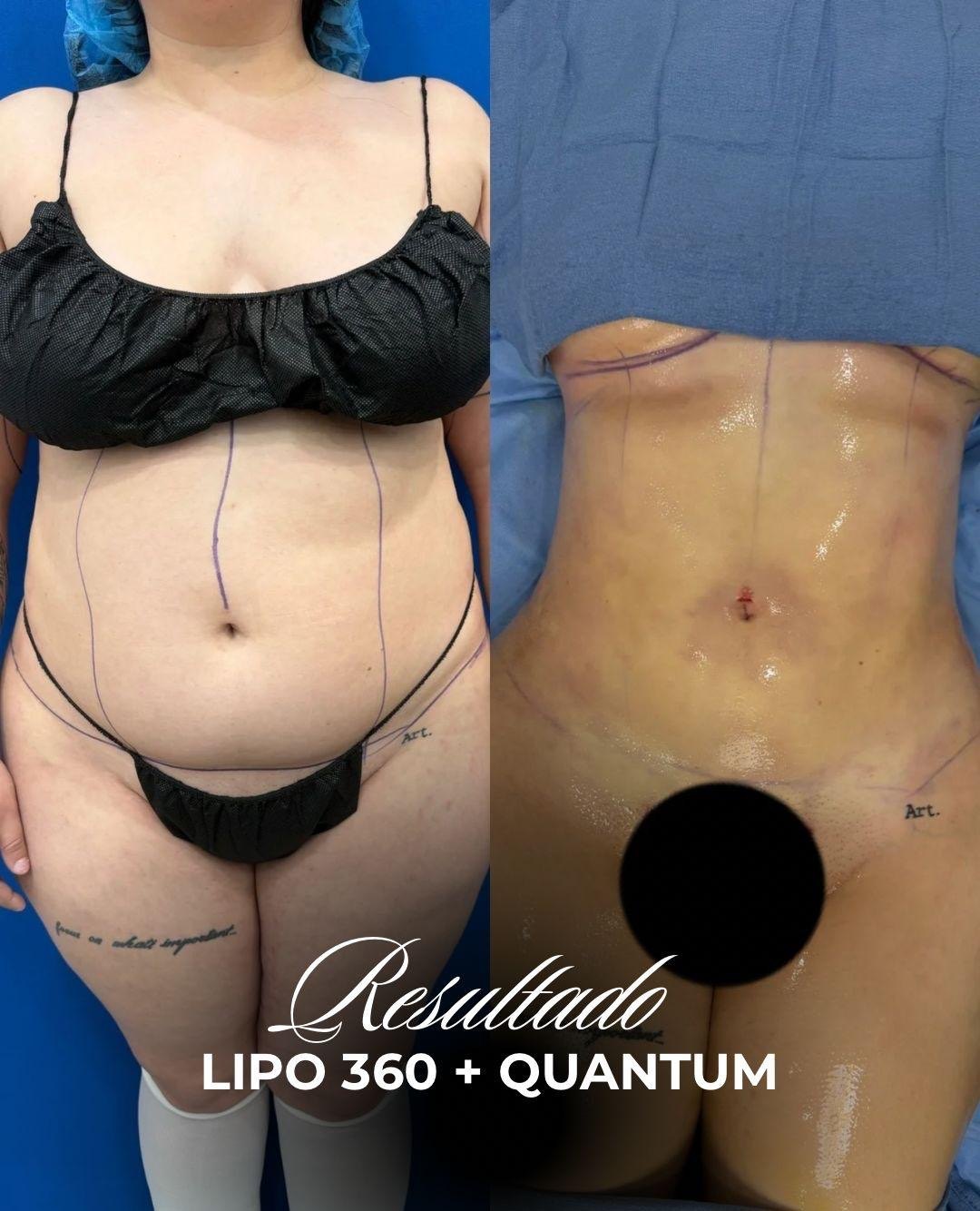 Paciente real de Lipo 360° en BET Aesthetics Center