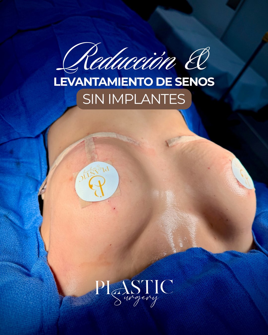 Paciente real de Reducción de Senos en BET Aesthetics Center