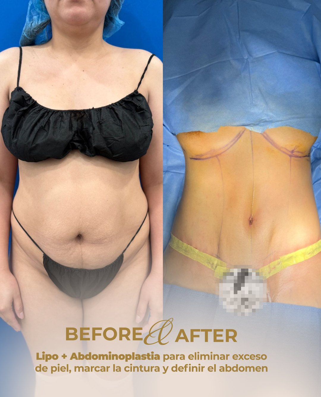 Paciente real de Tummy Tuck en BET Aesthetics Center
